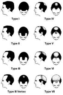 Norwood Hair Loss Scale Dallas Fort Worth Texas